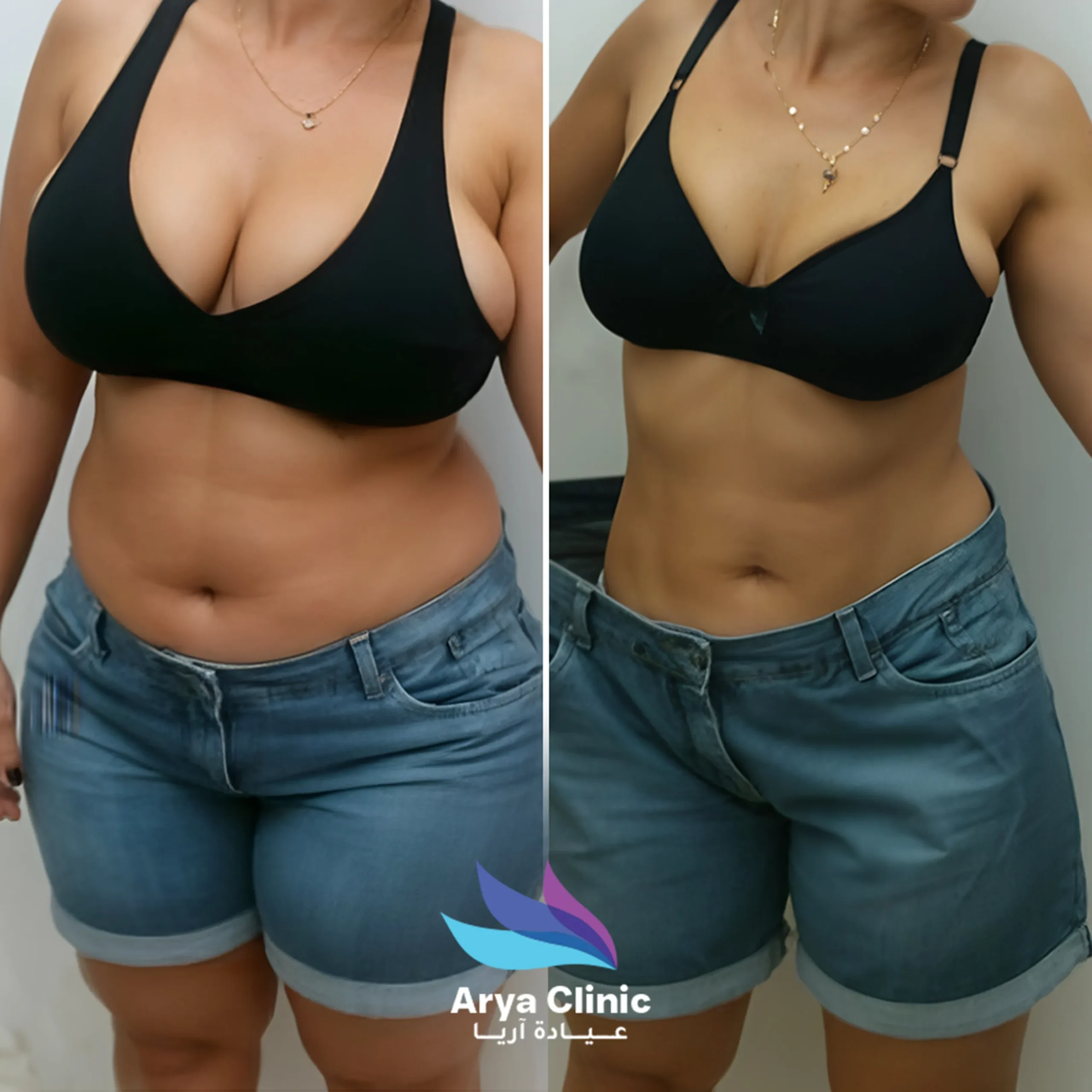 best liposuction surgery