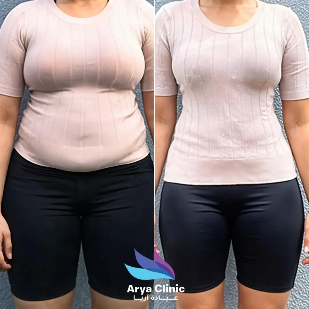 liposuction before after