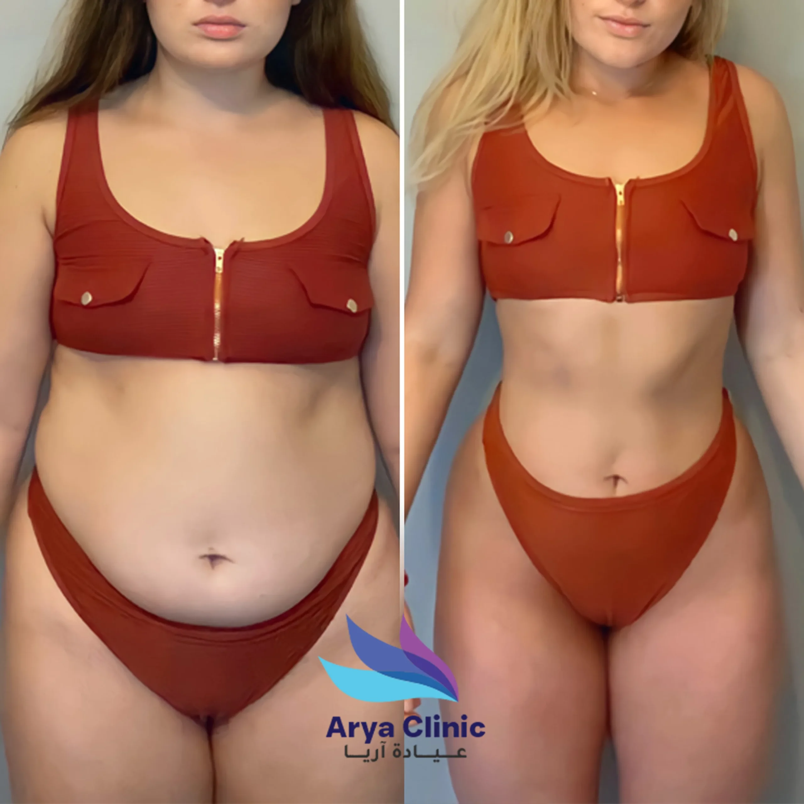 liposuction result