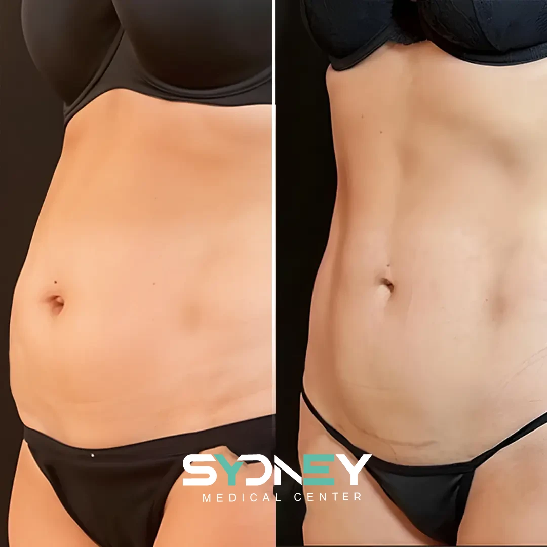 Lipo Before and After Sydeney 1