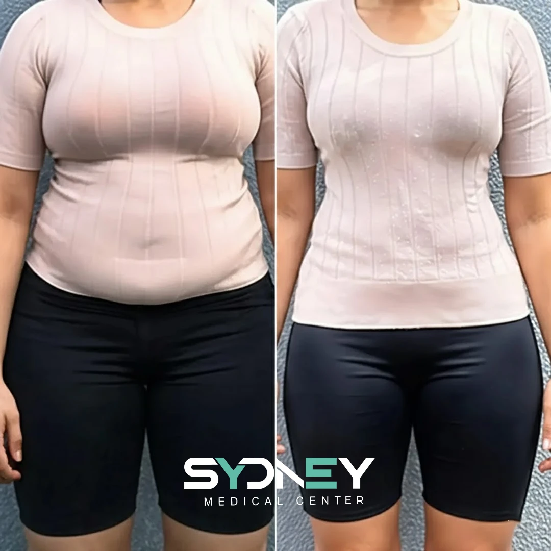 Lipo Before and After Sydeney 10