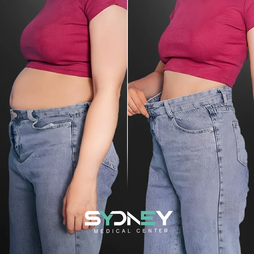 Lipo Before and After Sydeney 11