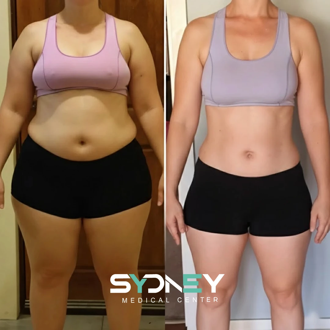 Lipo Before and After Sydeney 2