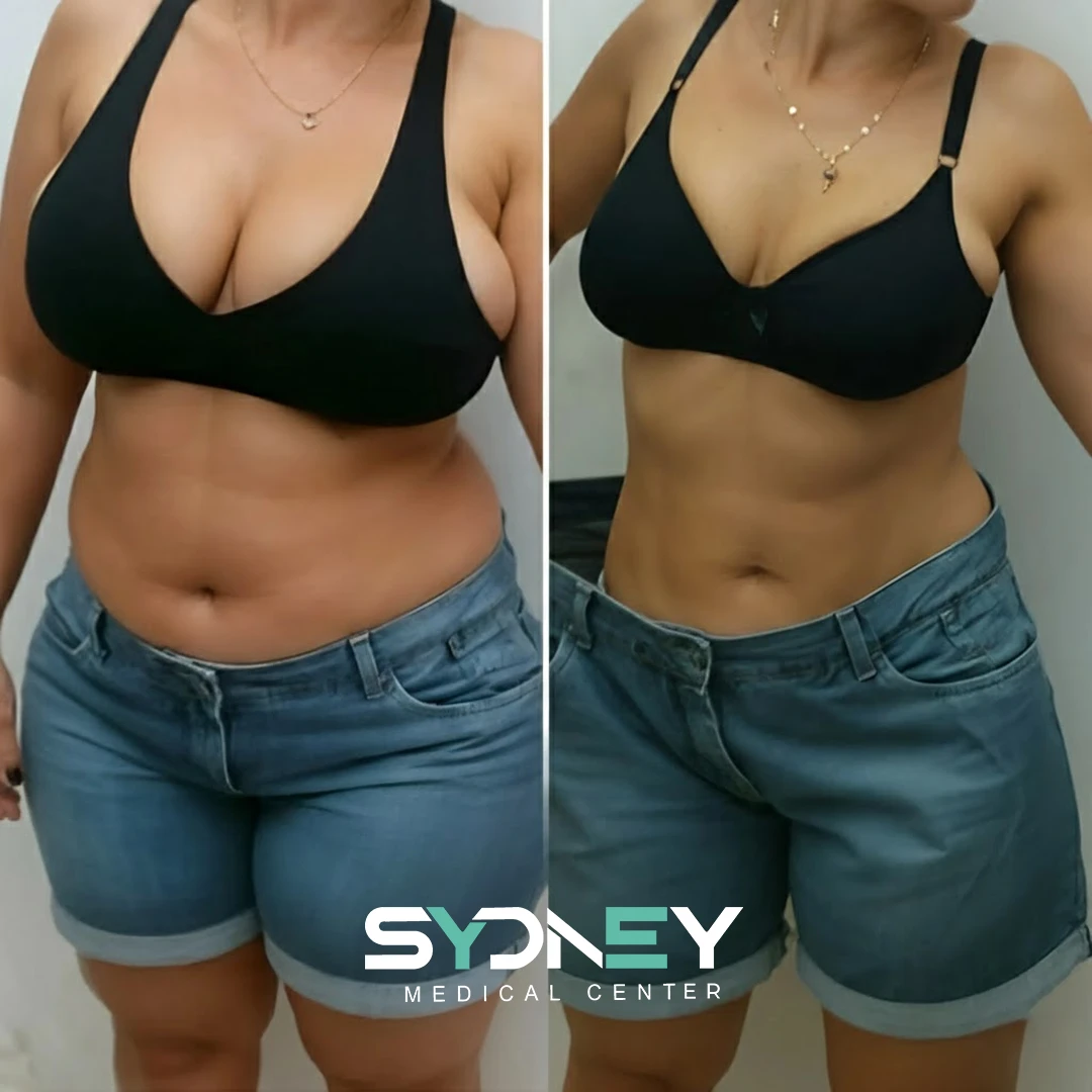 Lipo Before and After Sydeney 3
