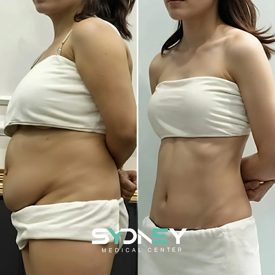 Lipo Before and After Sydeney 4