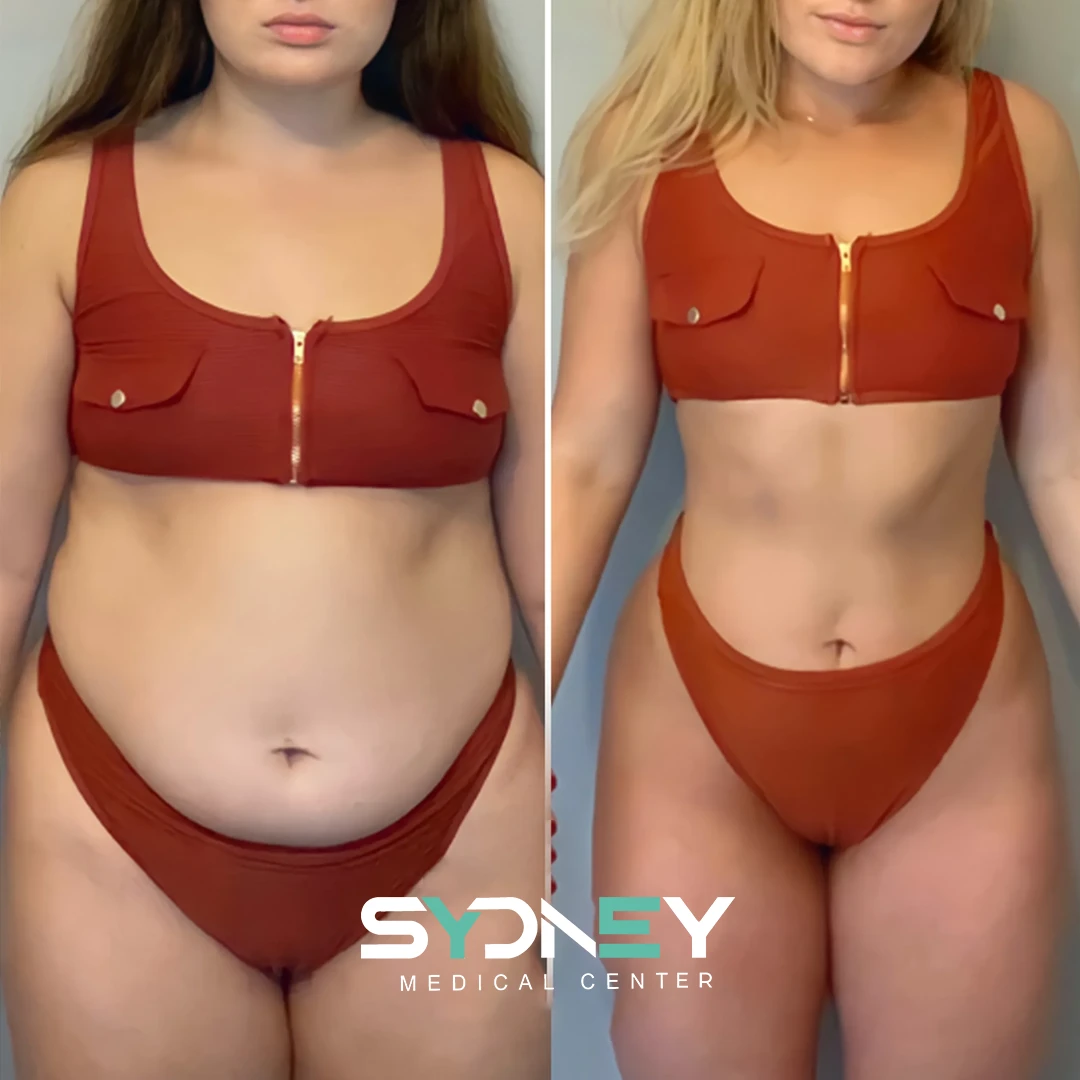 Lipo Before and After Sydeney 5