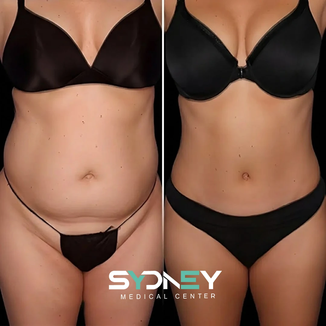 Lipo Before and After Sydeney 7