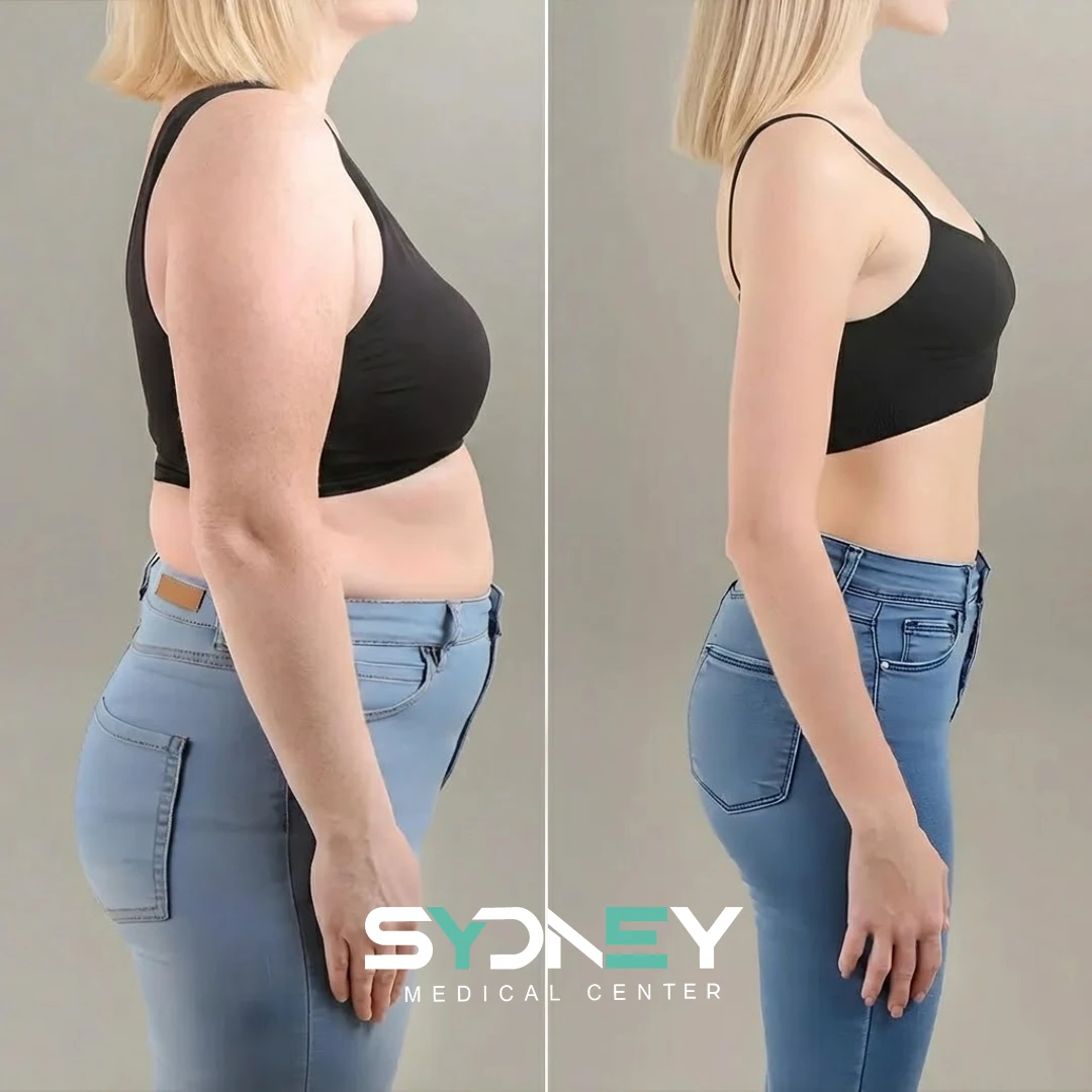 Lipo Before and After Sydeney 8