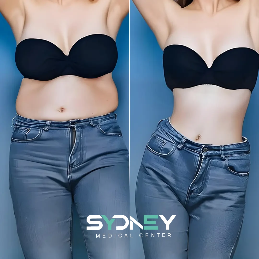 Lipo Before and After Sydeney 9