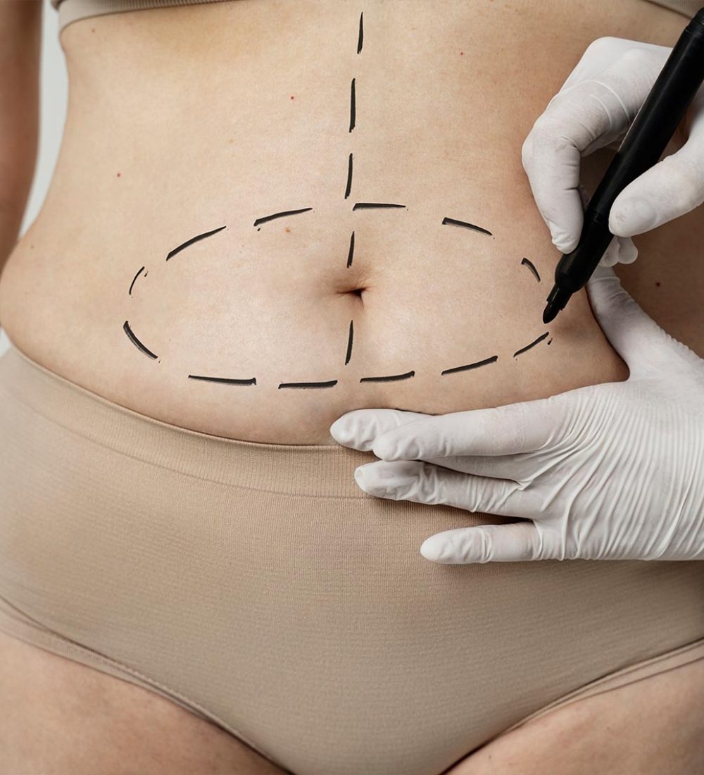 Abdominal Lipo