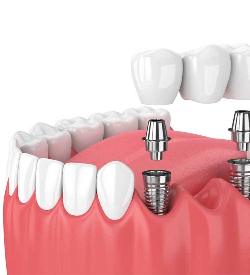 dental-implants-dubai-2